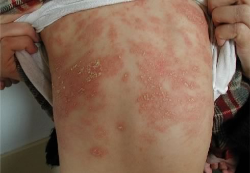 как лечится аллергический дерматит у детей?