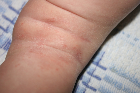 от чего шелушится кожа у новорожденных детей
