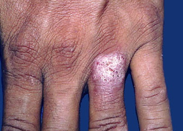 Туберкулез кожи фото начальная стадия 37