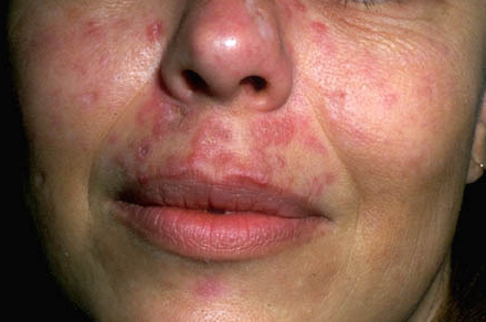 Туберкулез кожи фото начальная стадия 36