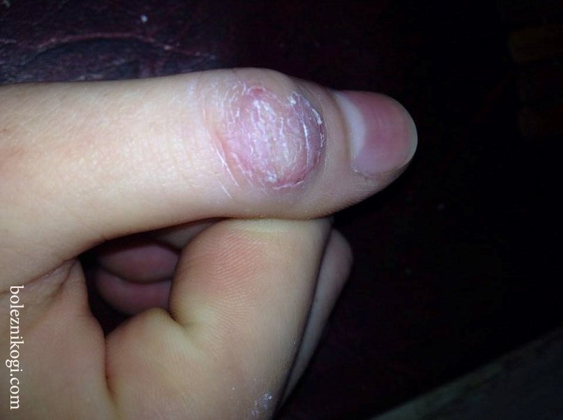 фото микоз гладкой кожи на пальце