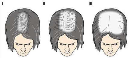 стадии выпадения волос