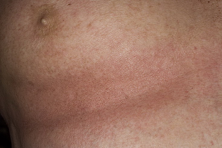 atopicheskij-dermatit-u-vzroslyx-lechenie-foto