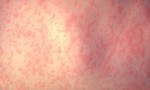 allergicheskij-dermatit-u-vzroslyx