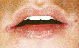 Трещины в уголках рта, какие причины и лечение у взрослых
