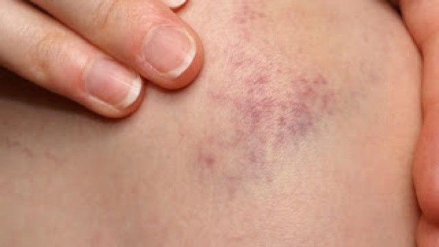 varikoznyj-dermatit