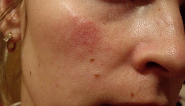 allergicheskij-dermatit-lica