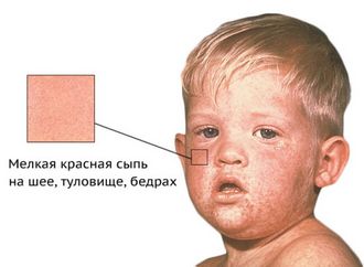 infekcionnyj-dermatit