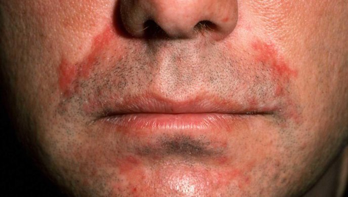 peroralnyj-dermatit-na-lice