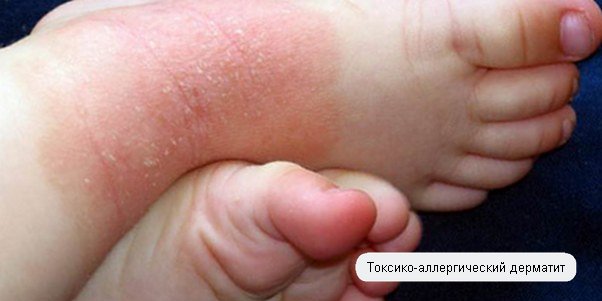Токсико-аллергический дерматит