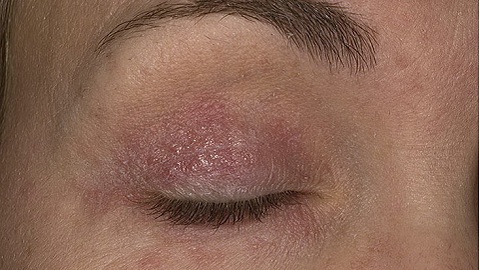 ekzematoznyj-dermatit-na-lice-foto