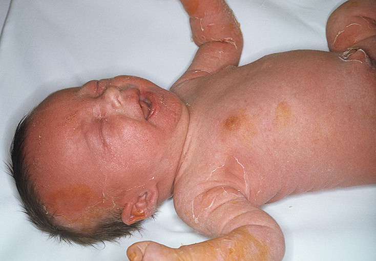 Эксфолиативный дерматит у новорожденных фото