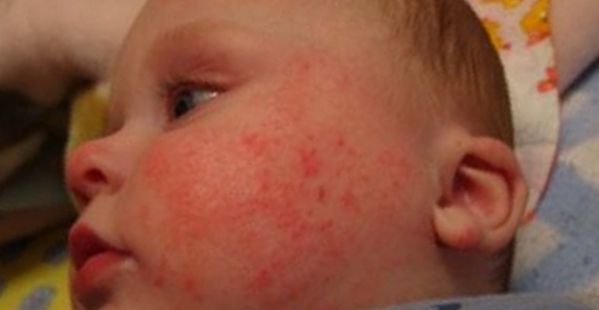 аллергически дерматит у детей