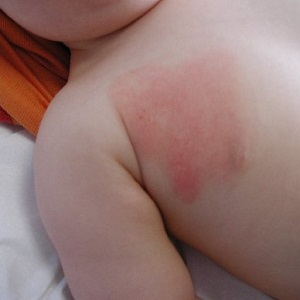 дерматит Аллергический у новорожденных фото