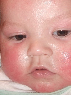 дерматит Атопический у новорожденных фото