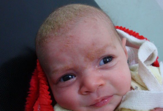 дерматит себорейный у новорожденных фото