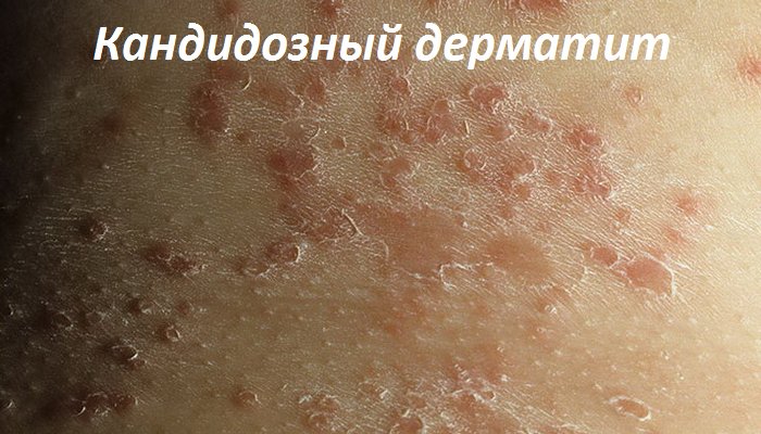 Кандидозный дерматит, его проявления и способы лечения