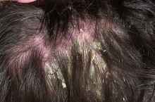 Первые симптомы при псориазе волосистой части головы