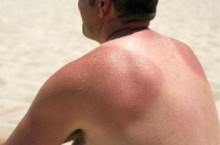 Причины появления солнечного дерматита у взрослых и детей