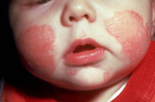 Развитие контактного дерматита у детей