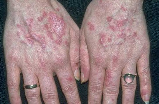 Туберкулез кожи фото начальная стадия 32