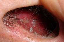 Герпес в носу: причины, симптомы, лечение