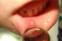 Как проходит лечение хейлита на губах?