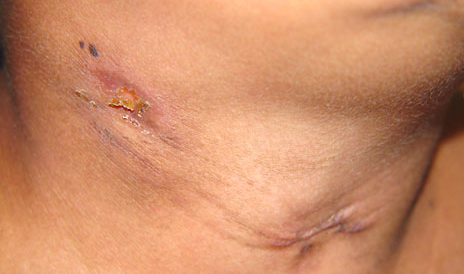 Угревая сыпь после лечения туберкулеза thumbnail