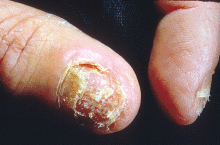 Грибок на ногтях: моя история выздоровления
