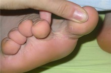 Грибок между пальцами ног: фото, признаки, лечение