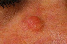 Злокачественные опухоли кожи: фото, причины, лечение