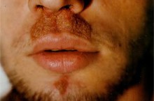 Сикоз носа: причины появления и методы лечения