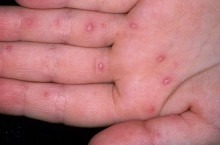 Лечение вирусной пузырчатки у ребенка