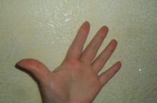 Аллергия на руках: фото, симптомы и применяемые методы лечения
