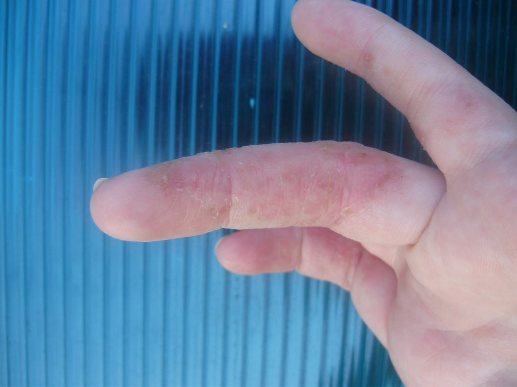 Зудящие пупырышки на коже рук thumbnail