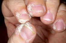 Ониходистрофия ногтей: причины появления и классификация заболевания