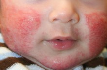 Атопический дерматит у детей: фото, причины, лечение