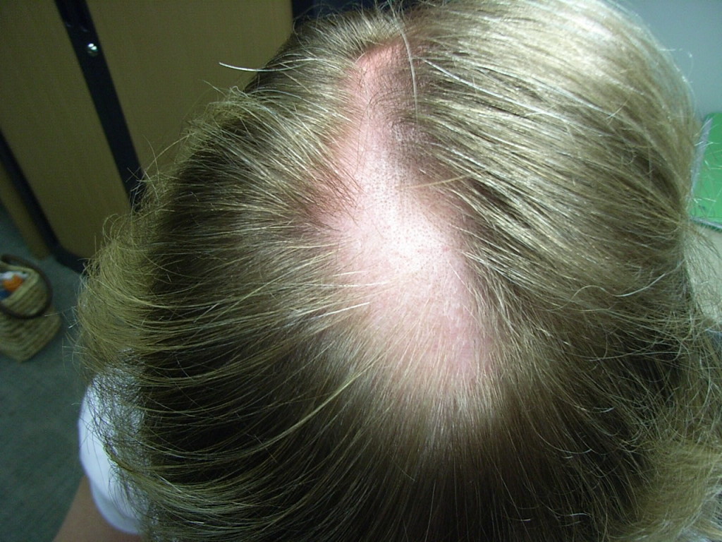 Болезнь выпадение волос алопеция фото