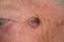 Плоскоклеточный рак кожи: фото, симптомы, лечение