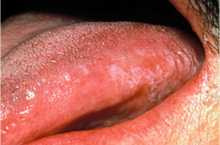 Лейкоплакия полости рта: фото, признаки, лечение