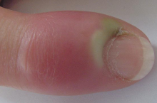 Что делать, если опух палец возле ногтя?