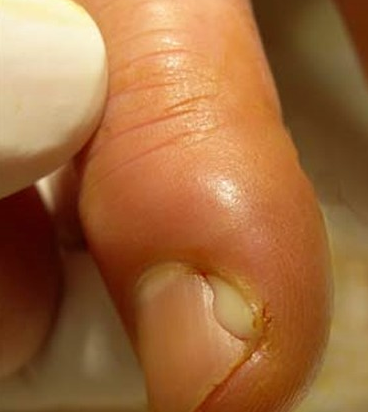 Опух палец в области ногтя что делать thumbnail