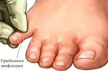 Народные средства от грибка ногтей на ногах