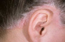 Псориаз в ушах – как справиться с этой проблемой