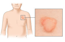 Как вылечить розовый лишай у ребенка
