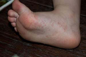 prichiny-poyavleniya-dermatita