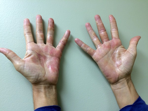 Зудящие пупырышки на коже рук