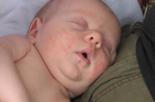 Причины и лечение сыпи на щеках у новорожденного