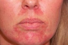 Правильное лечение себорейного дерматита на лице