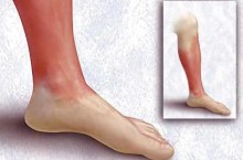 Рожистое воспаление ноги симптомы и лечение